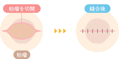 切開法