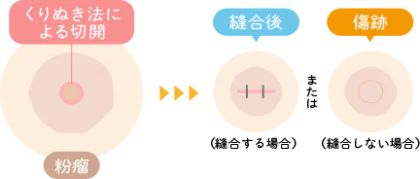 くりぬき法